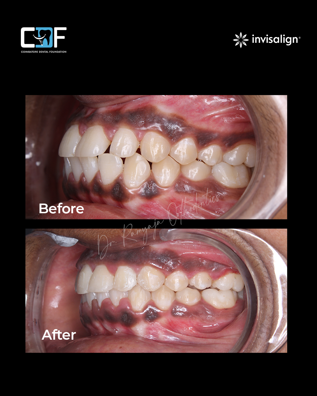 Before After Result
